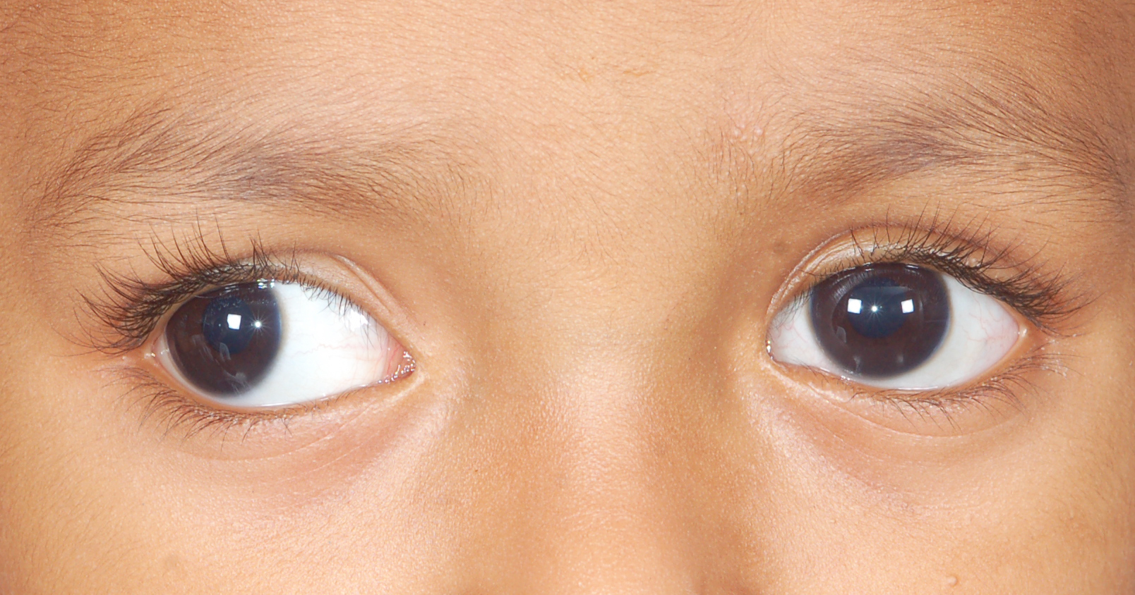 phfi-cehj-common-eye-diseases-in-school-going-children