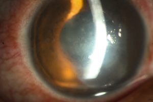 PHFI CEHJ » Herpes simplex infection of the eye: an introduction