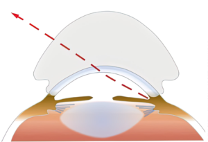 PHFI CEHJ » Gonioscopy skills and techniques