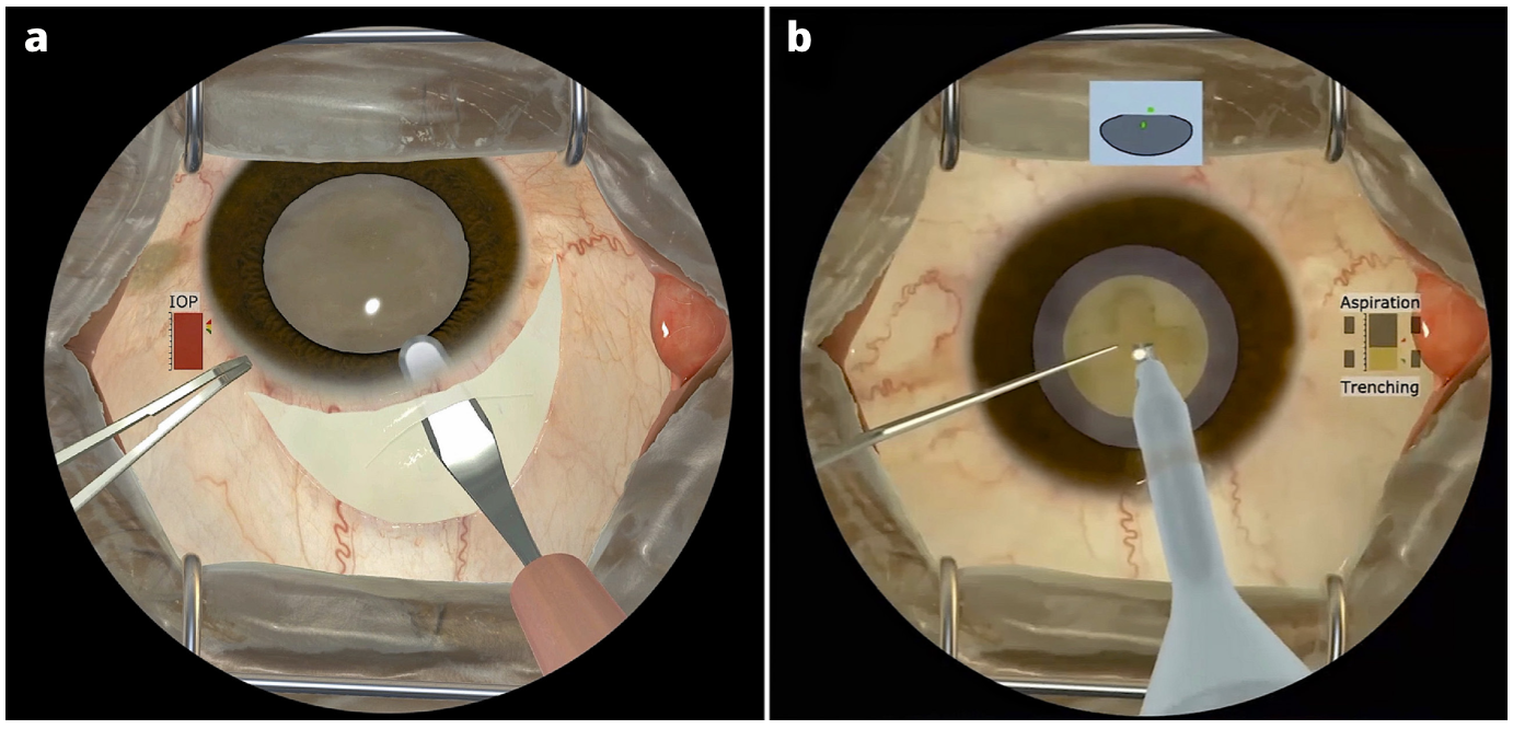 Phfi Cehj » More Than Simulation: The Helpmesee Approach To Cataract 