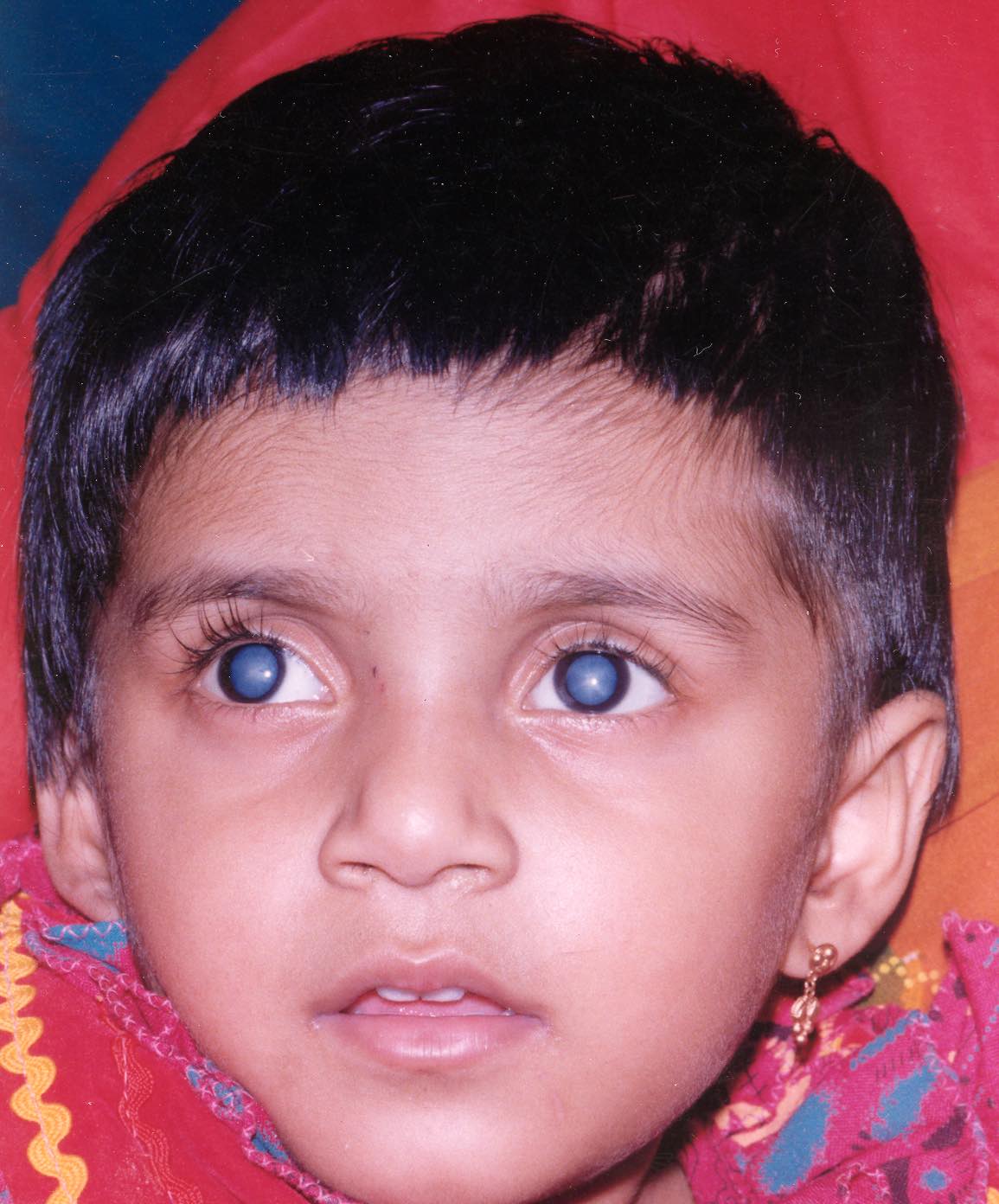 A child with dense, bilateral cataract. Both eyes are likely to be amblyopic if the cataracts were present since birth. INDIA (Photo: ©Aravind eye care CC BY-NC-SA 4.0)