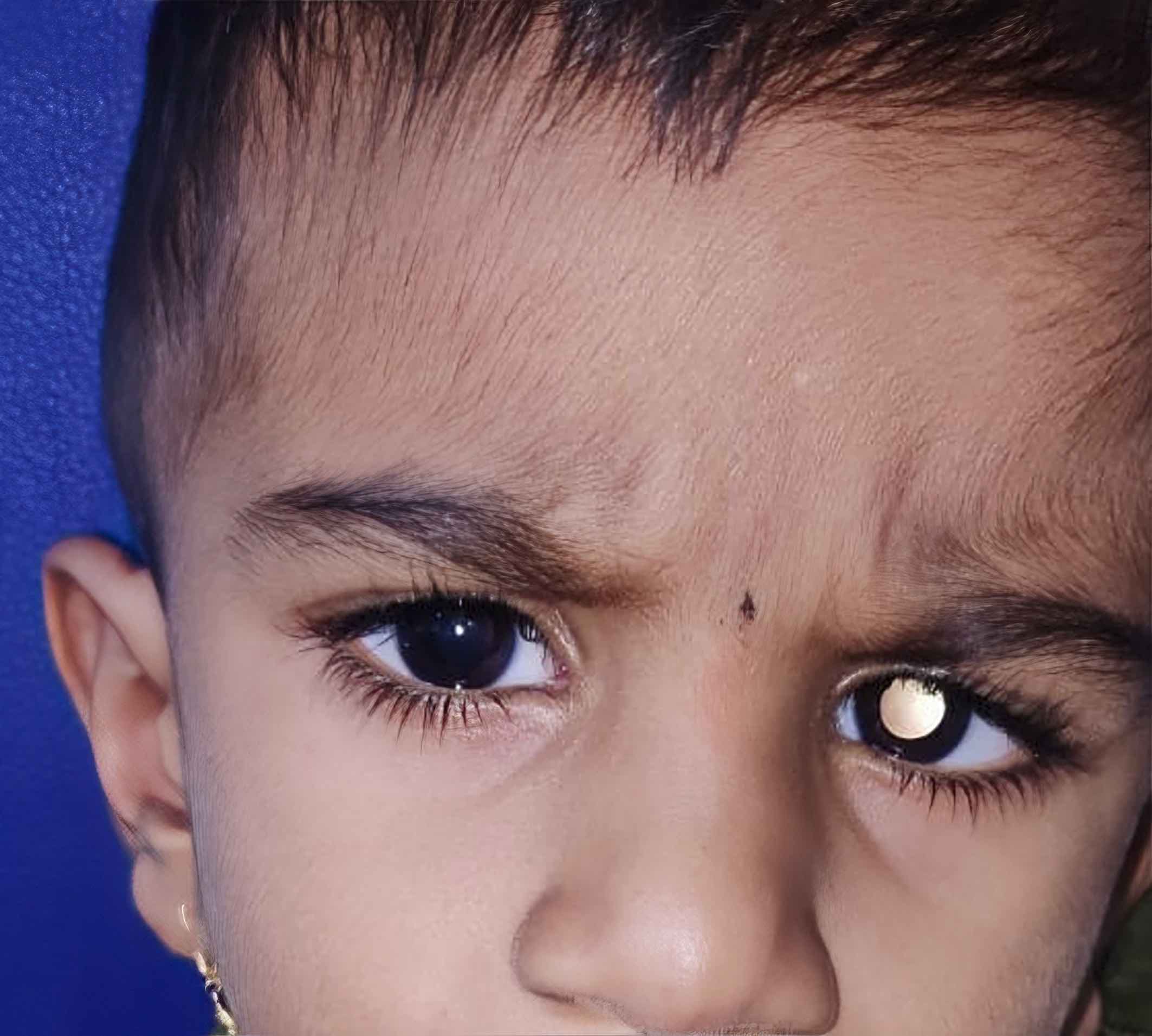 A child with retinoblastoma in the left eye, visible when using a torch light or ophthalmoscope to elicit the red reflex. INDIA (Photo: © Shilpa Sonarkhan CC BY-NC-SA 4.0)