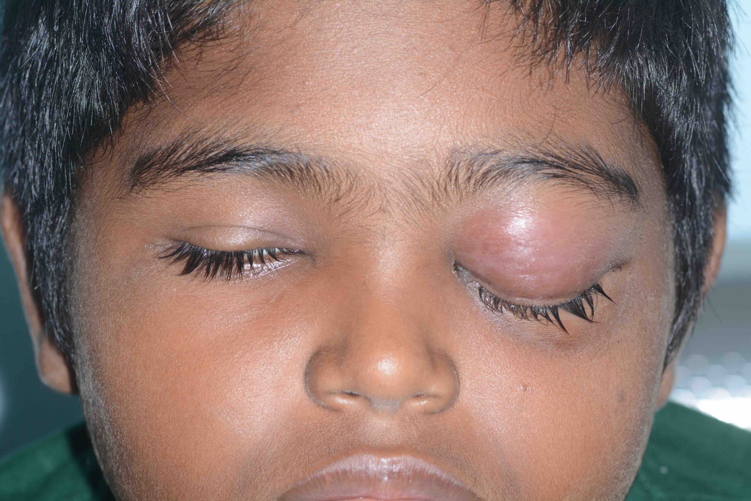 A child with orbital cellulitis who was admitted for treatment. INDIA (Photo:©Aravind eye care CC BY-NC-SA 4.0)