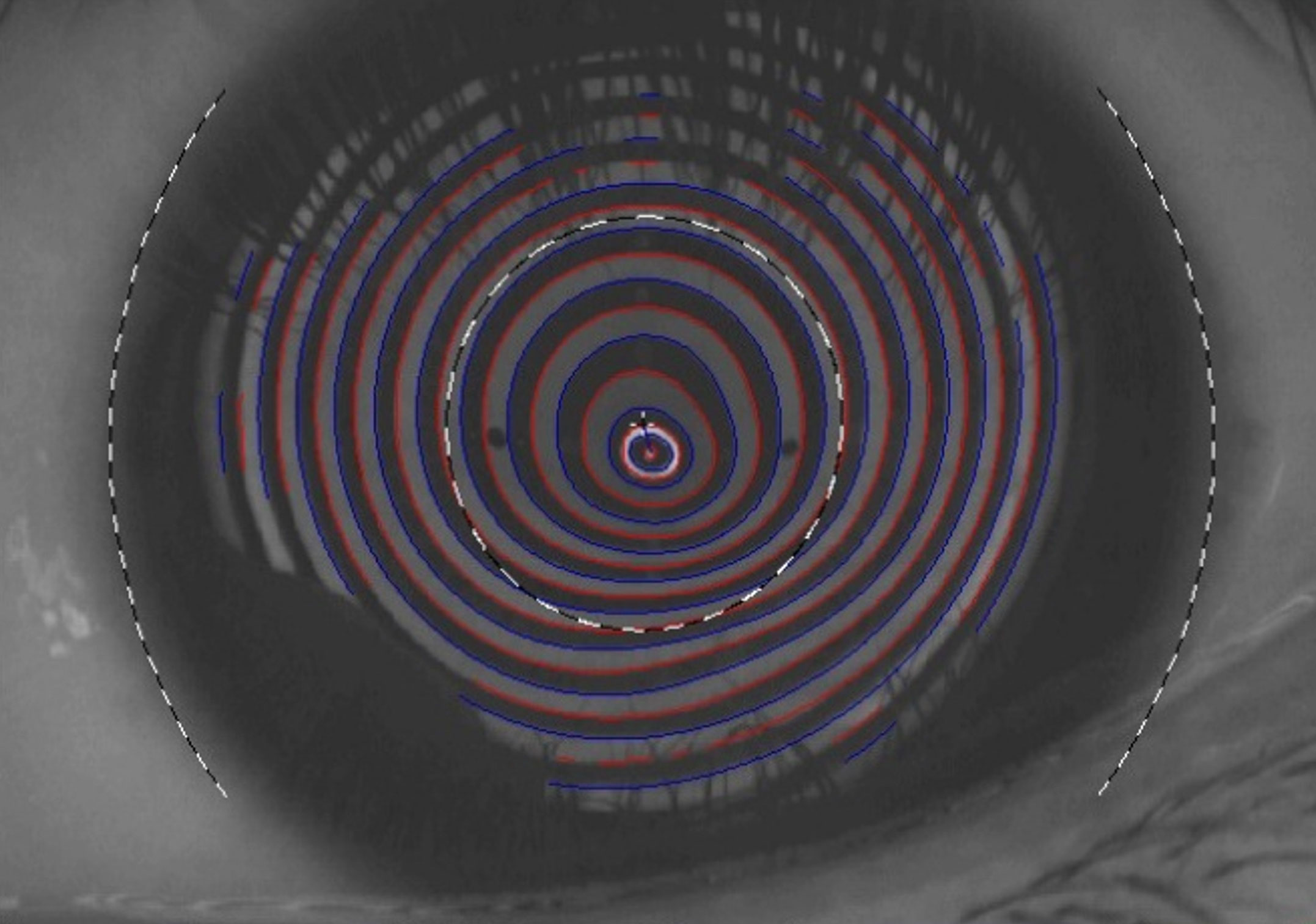 Figure 1- Image of Placido rings in keratoconus. The mires are closer to each other inferiorly, indicating an area where the cornea is steeper. (Photo: © ICEH CC BY-NC-SA 4.0)