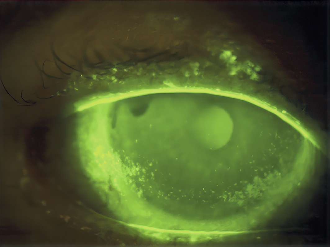 Punctate epithelial erosions characteristic of dry eye. Image taken using blue light and a yellow filter, after instilling fluorescein. UK. (Photo: © VICTOR HU CC BY-NC-SA 4.0)